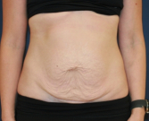 Feel Beautiful - Texas Tummy Tuck - Before Photo